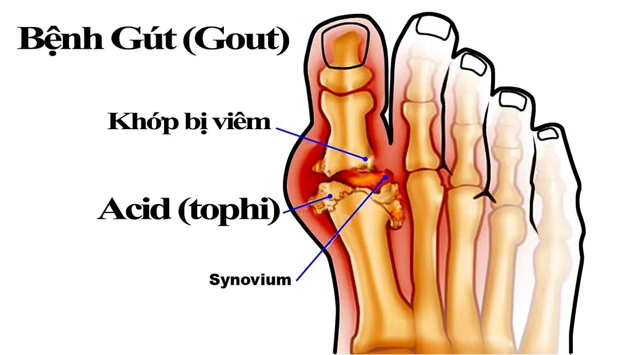 Bệnh GOUT có dùng được tổ yến